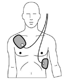 Défibrillation semi-automatique : positionnement des électrodes